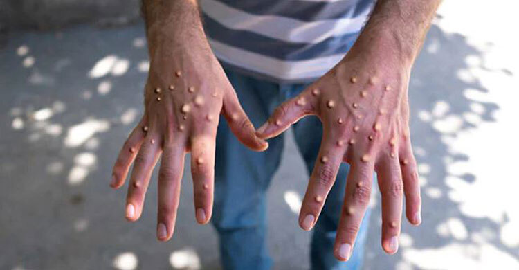 mpox