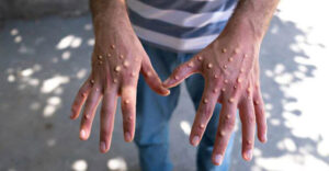 mpox